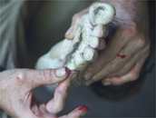 Trenchfoot